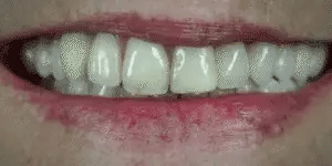 NovaBright Facette Snap On per Denti Superiori e Inferiori Sorriso Naturale Istantaneo | Lersk