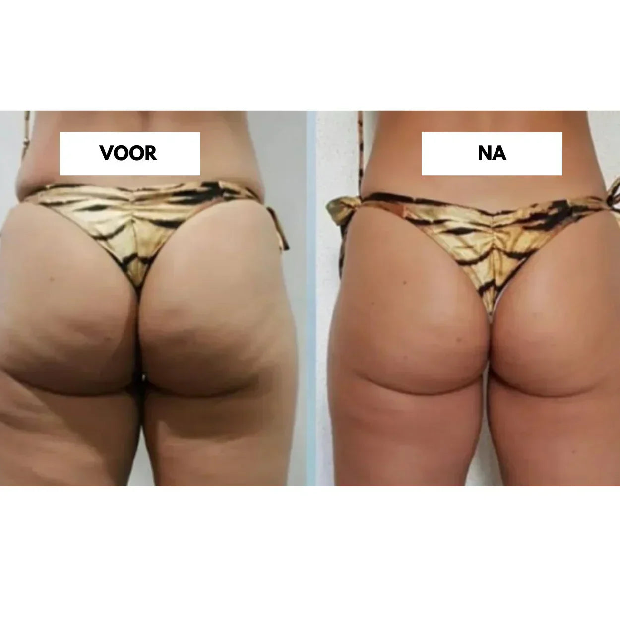 CelluLift Cellulite Vakuummassager til Kvinder Fast Hud | Lersk