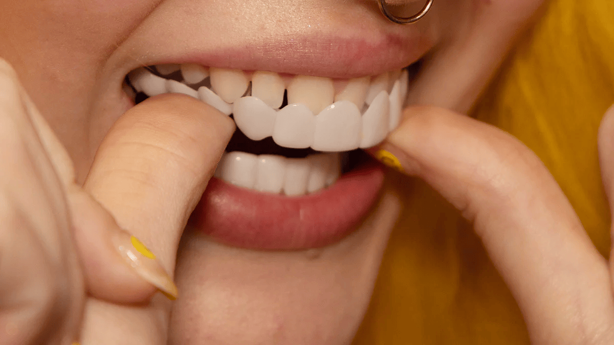 NovaBright Facette Snap On per Denti Superiori e Inferiori Sorriso Naturale Istantaneo | Lersk