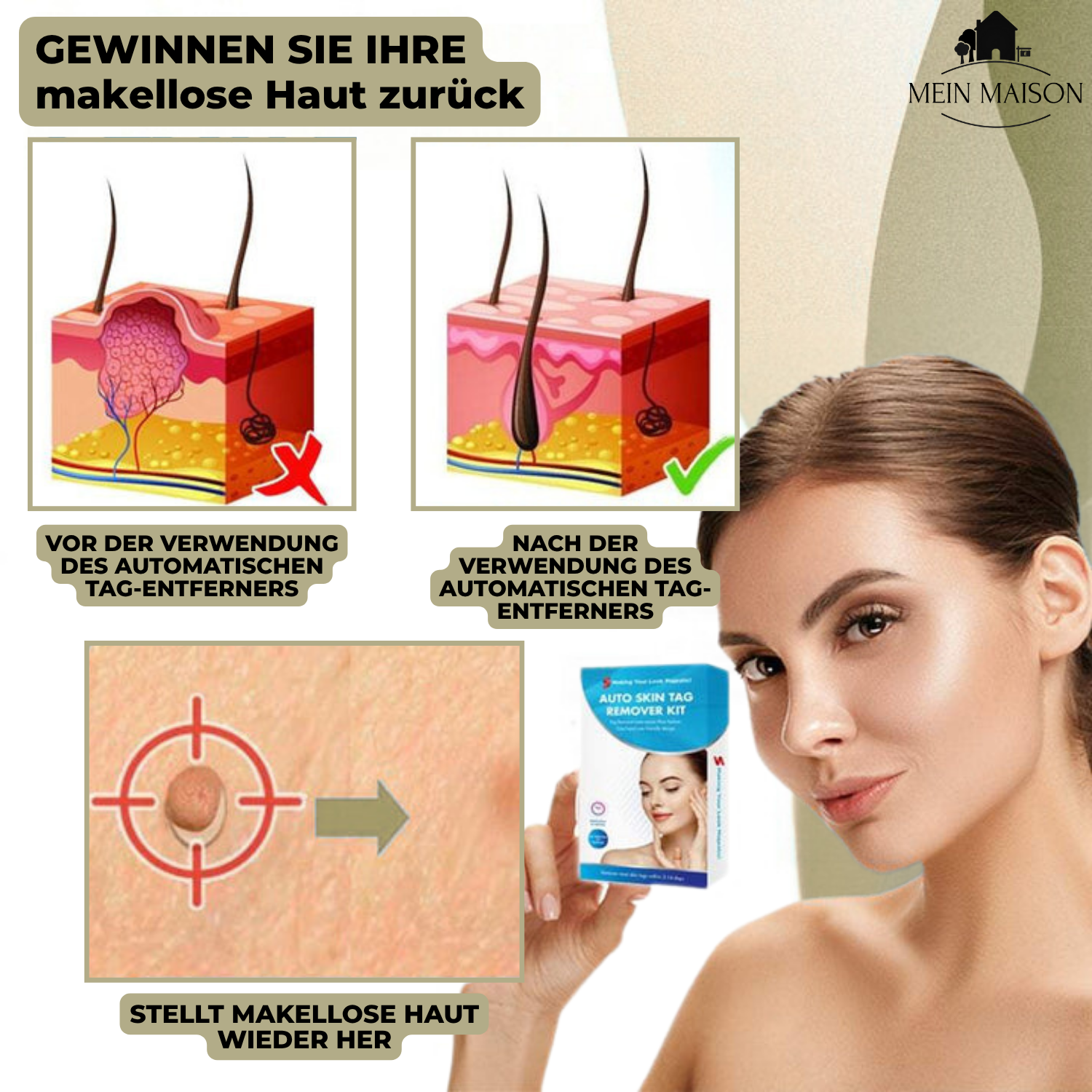 DermaLinx Warzenentferner für den Heimgebrauch Schmerzfreie Entfernung von Warzen und Muttermalen ohne Operation | Lersk