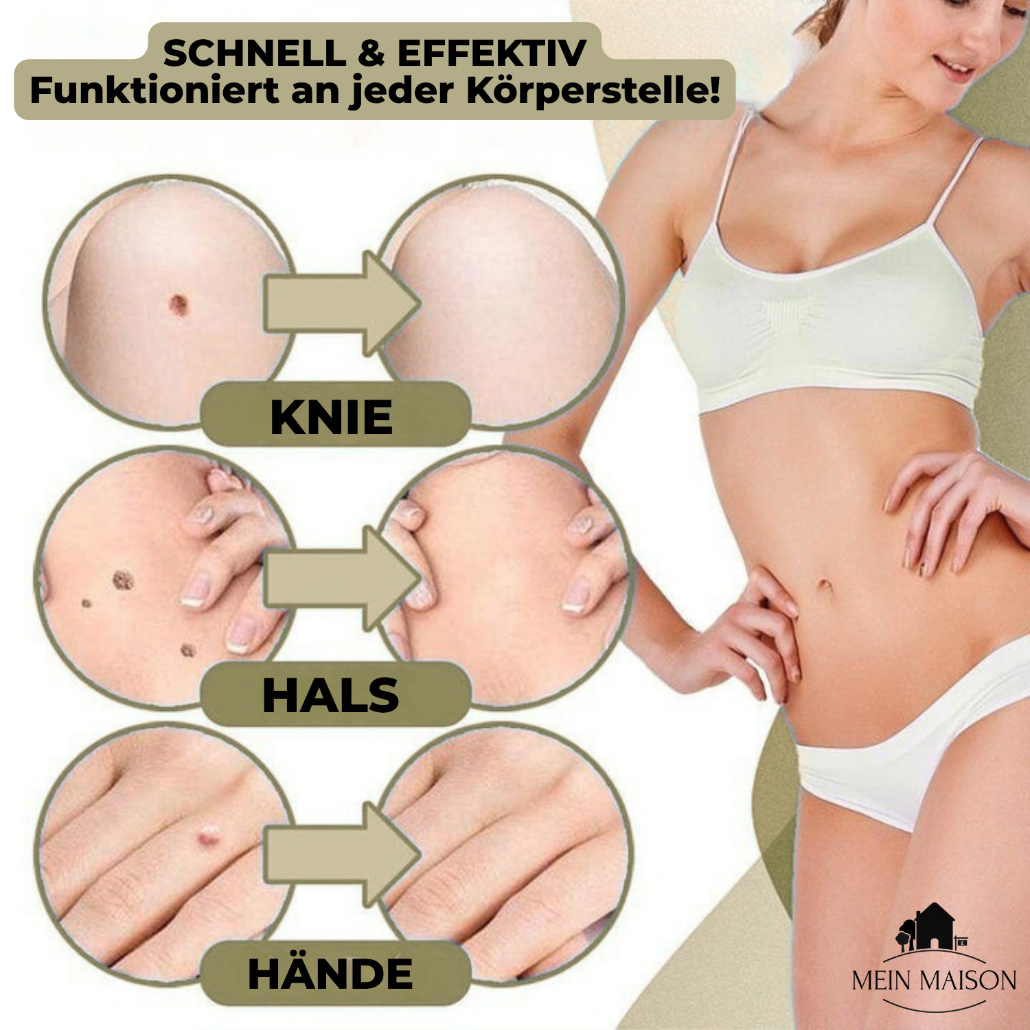 DermaLinx Warzenentferner für den Heimgebrauch Schmerzfreie Entfernung von Warzen und Muttermalen ohne Operation | Lersk