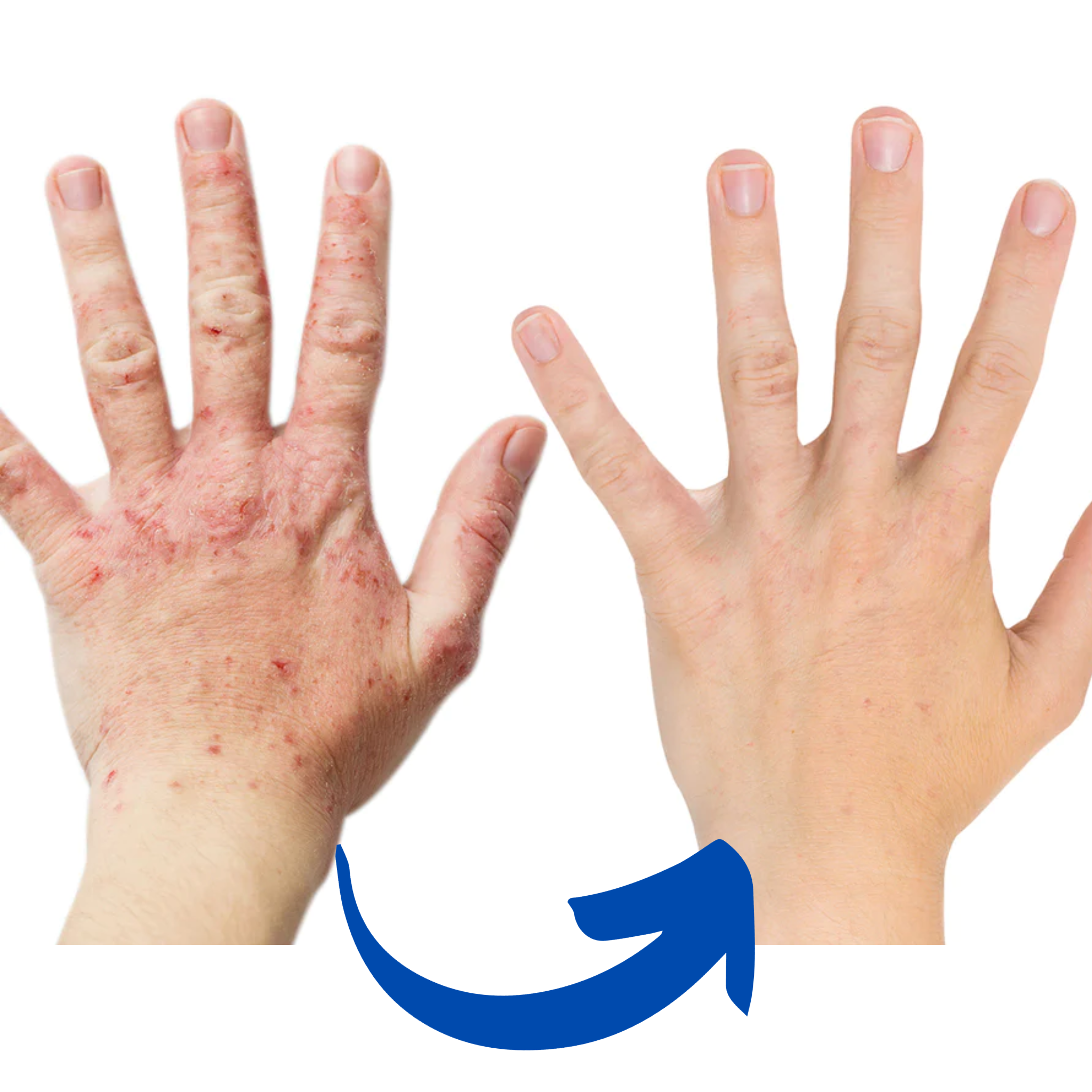 Guanto per Artrite con Terapia a Luce Rossa per Sollievo dal Dolore alla Mano | Lersk