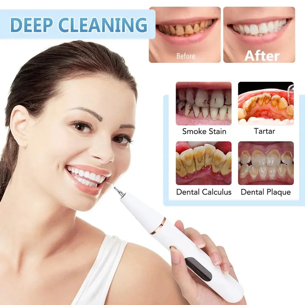 SonicDent 38 kHz Ultrasonic Teeth Cleaner With LED & USB | Lersk