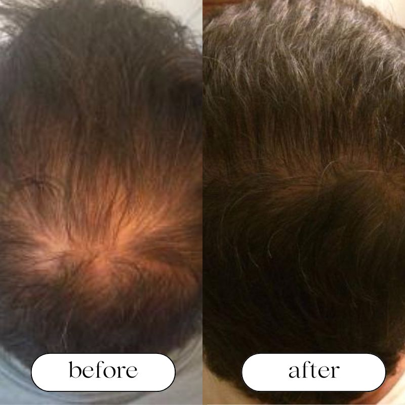 Red Light Therapy Cap For Hair Growth For Men And Women | Lersk