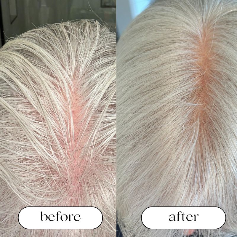 Red Light Therapy Cap For Hair Growth For Men And Women | Lersk