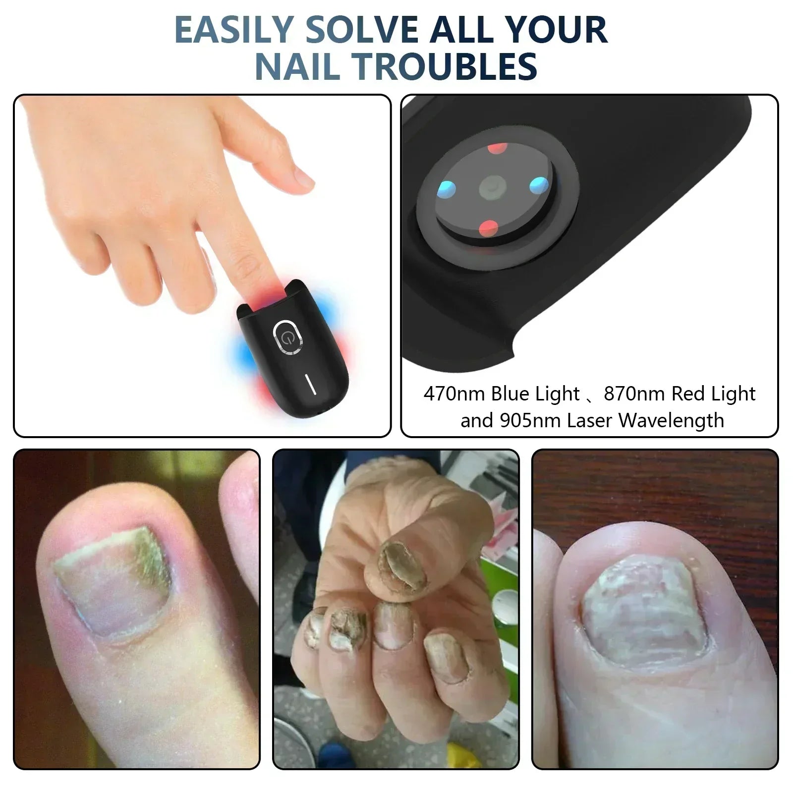 LumaToe Portable Laser Therapy for Toenails with USB Charge | Lersk