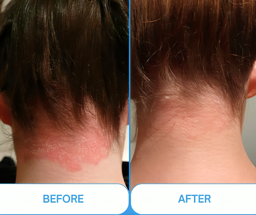 Lumara Pocket UVB-lysterapilampe 311nm til psoriasis og vitiligo | Lersk