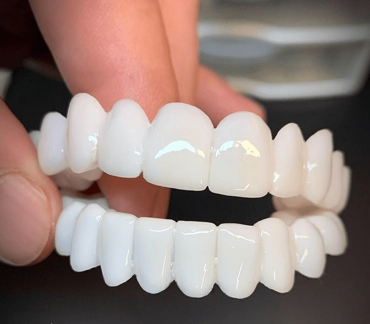 SmileFlex Dental Prosthesis With White Veneers For A Subtle, Lifelike Smile And Natural Look | Lersk