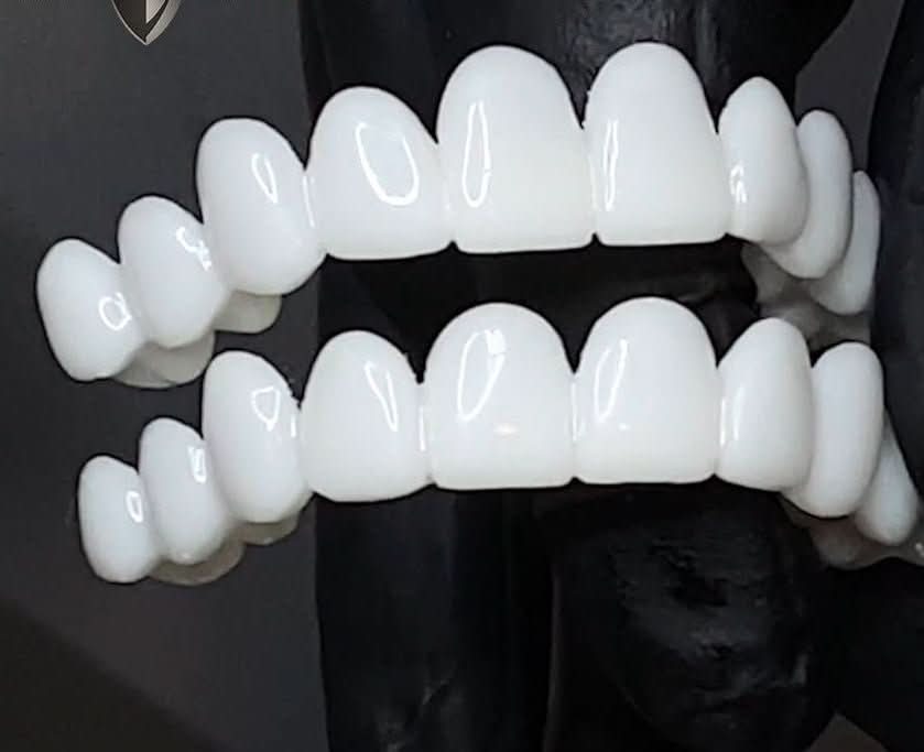SmileFlex Dental Prosthesis With White Veneers For A Subtle, Lifelike Smile And Natural Look | Lersk
