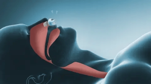 AstraLuma Nano CPAP Reise-Schlafhilfe ohne Schlauch Tragbare Therapie | Lersk