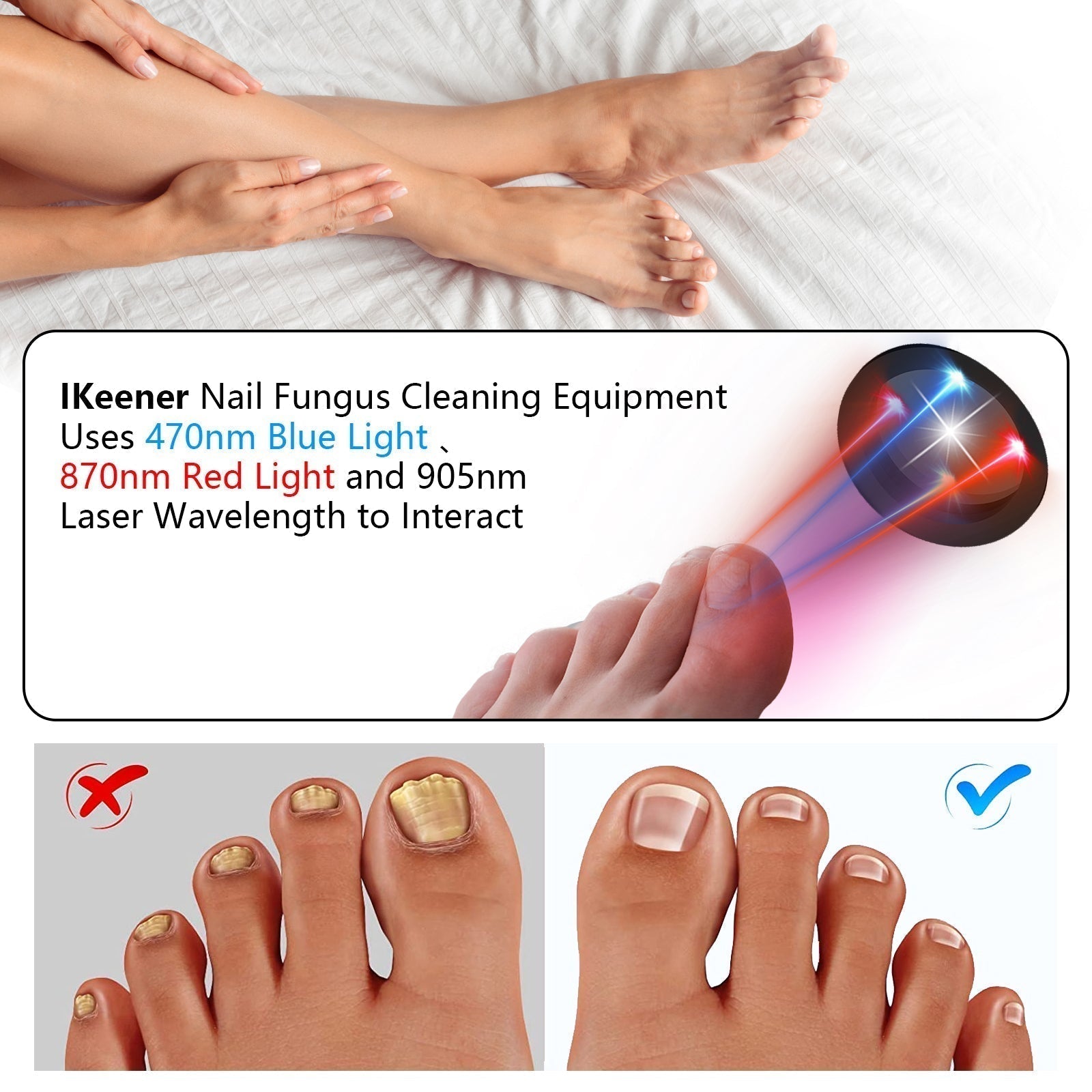 Tratamiento Láser para Hongos en las Uñas para Uso en Casa Sin Dolor | Lersk
