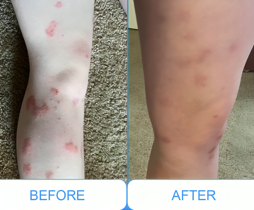 DermaLuma bærbar UVB-terapilampe til psoriasis og vitiligo derhjemme | Lersk