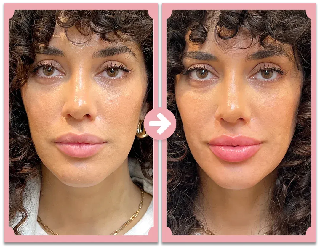 Poutify Plumping Lip System | Lip booster kit | Lersk