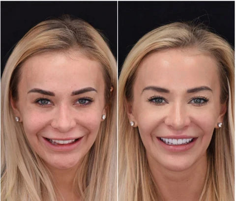 LumaGrin Facette Instantanee Adesive per Denti Superiori e Inferiori | Lersk