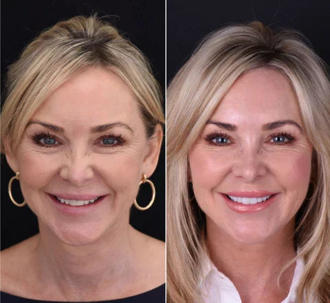 NovaBright Facette Snap On per Denti Superiori e Inferiori Sorriso Naturale Istantaneo | Lersk