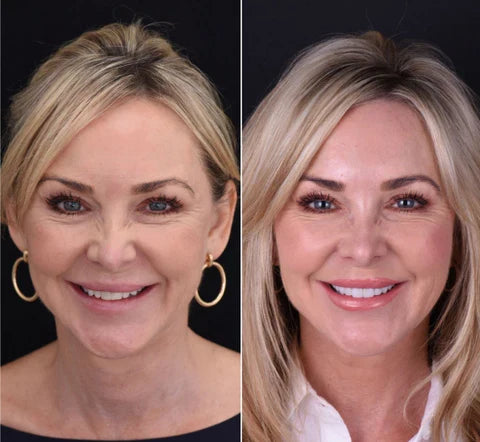 LumaGrin Facette Instantanee Adesive per Denti Superiori e Inferiori | Lersk