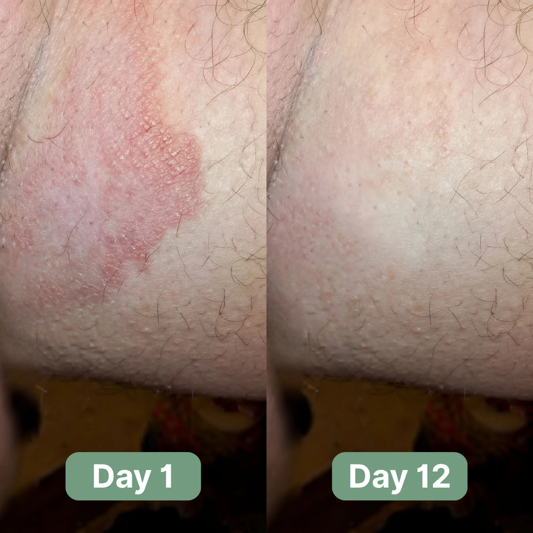 Veloma Antifungal Soap – Cílená úleva od tinea cruris | Lersk