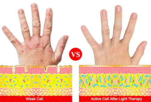 Guanti per terapia a infrarossi vicini ArthroGlow per artrite | Lersk