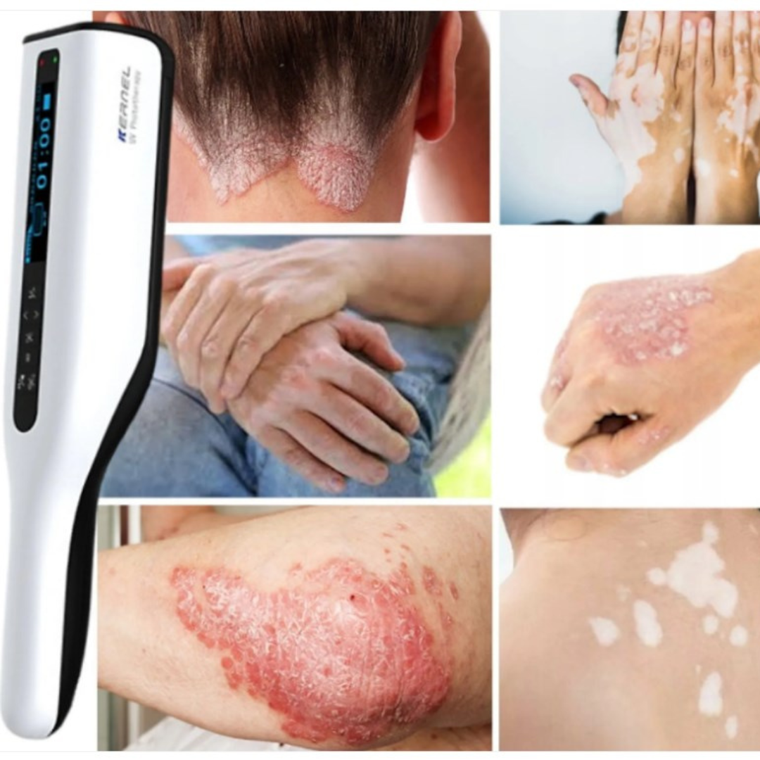 DermaLuma bærbar UVB-terapilampe til psoriasis og vitiligo derhjemme | Lersk