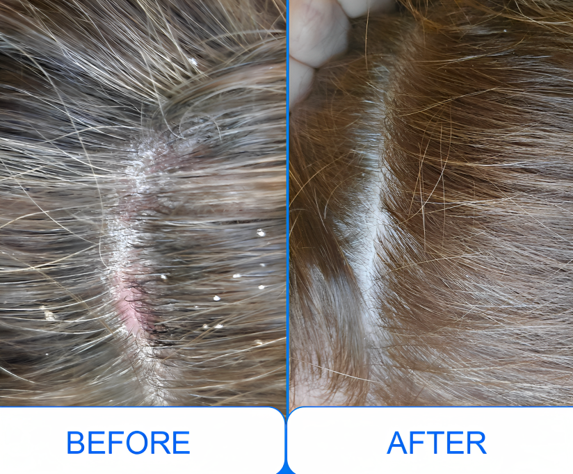 Lumara Pocket UVB-lysterapilampe 311nm til psoriasis og vitiligo | Lersk