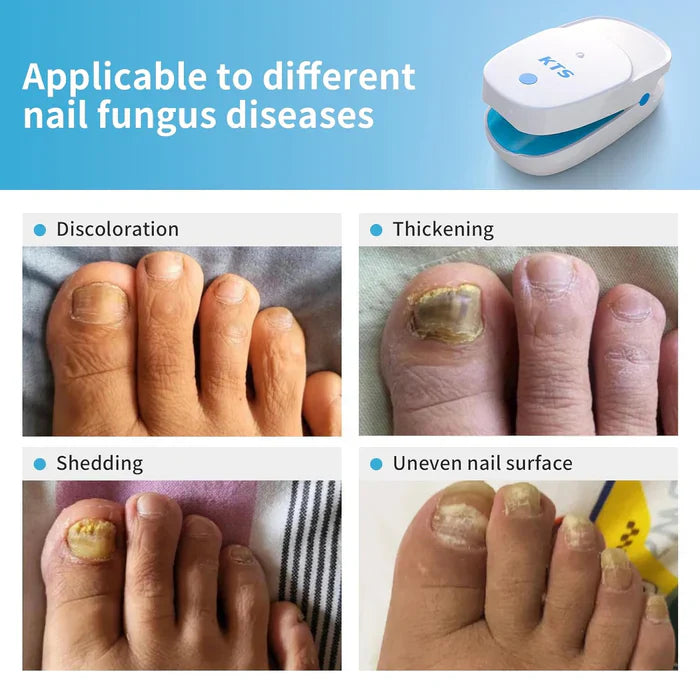 Duales Nagelpflege-Lasergerät mit 905nm- und 470nm-Licht für Nagelgesundheit | Lersk