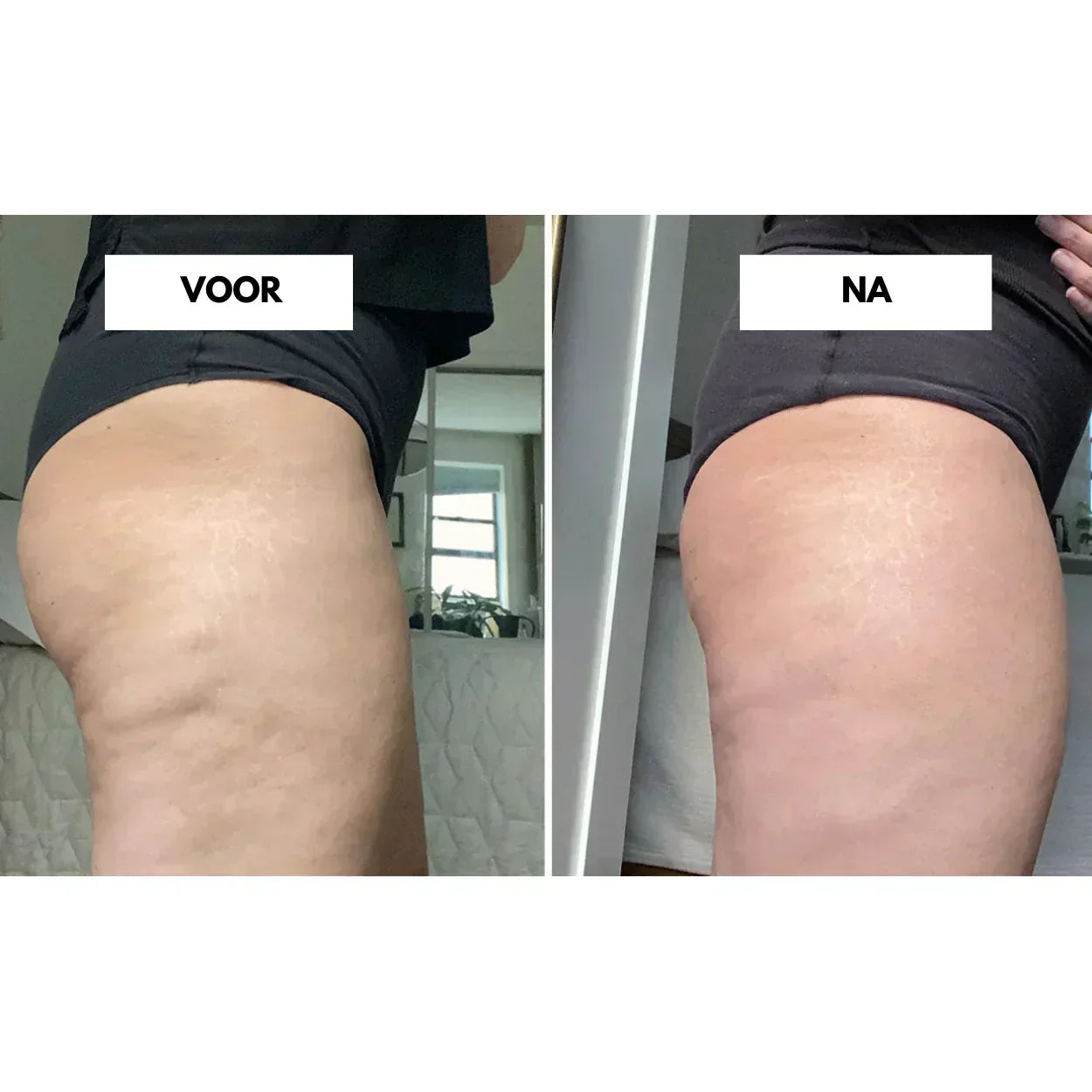CelluLift vakuový masážní přístroj proti celulitidě pro ženy Pevná pokožka | Lersk