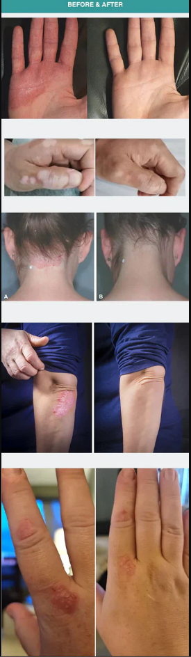 308nm UVB-Phototherapie-Lampe für Gesicht, Hals und Gliedmaßen mit 3 austauschbaren Lampenschirmen | Lersk