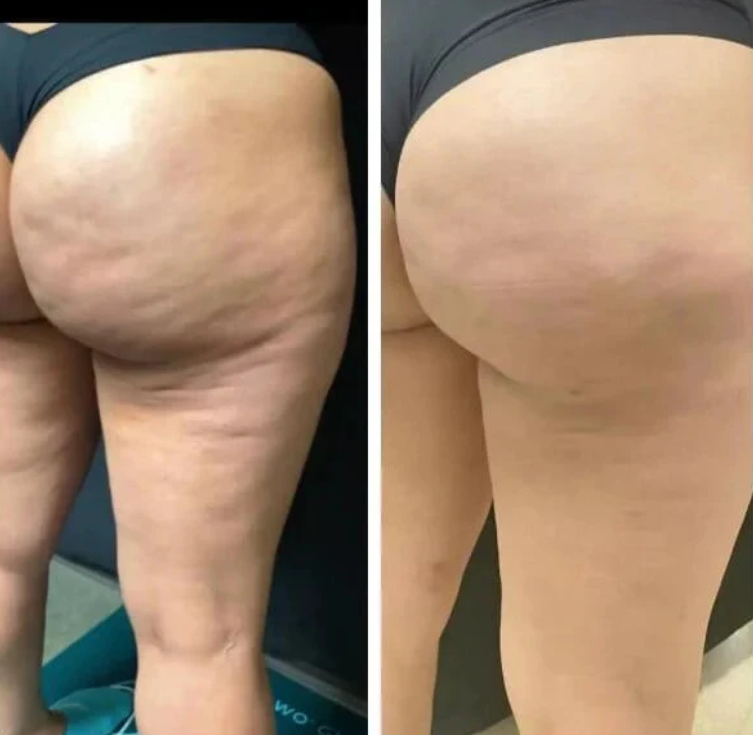 Anti-Cellulite-Massageöl – Fettabbau- und Hautglättungsformel | Lersk