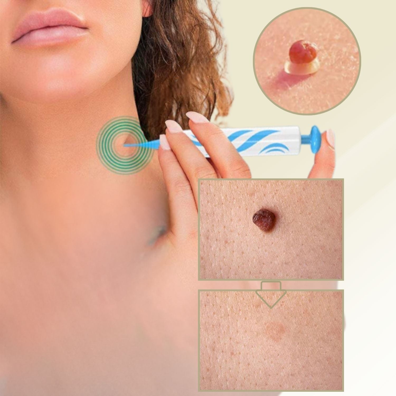 DermaLinx Warzenentferner für den Heimgebrauch Schmerzfreie Entfernung von Warzen und Muttermalen ohne Operation | Lersk