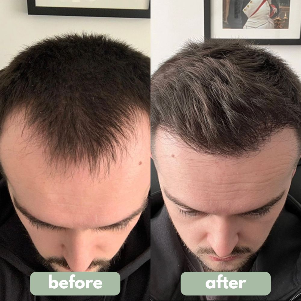 Roll-On Rivitalizzante per Capelli Pro-Crescita | Lersk