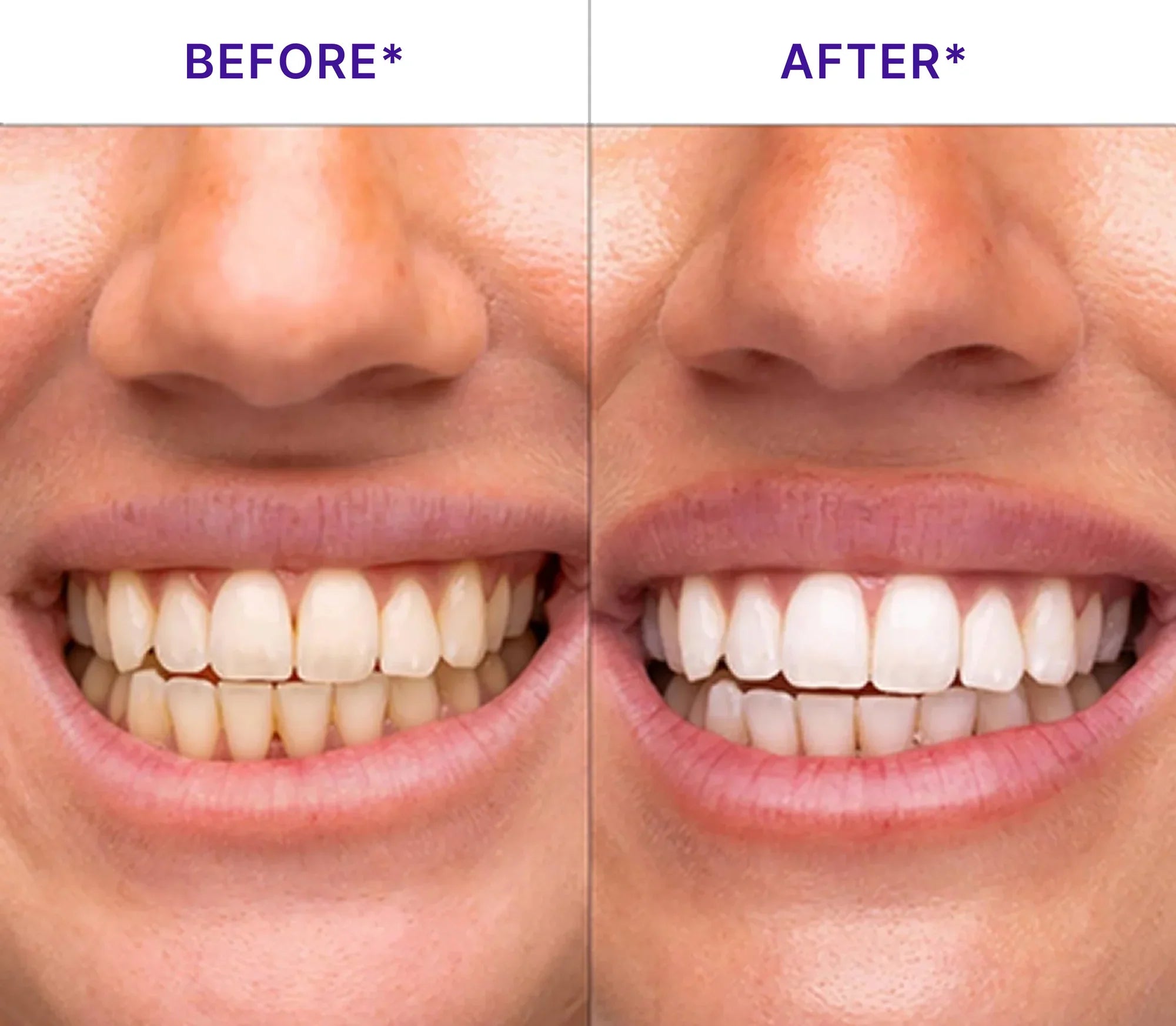 V34 Purple Whitening Strips – Instant Color-Correcting Teeth Whitening with PAP+ Technology | Lersk