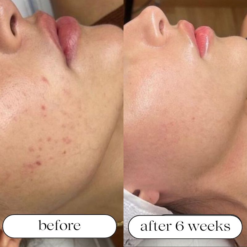 Medical Grade LED Light Therapy Machine With 7 Wavelengths | Lersk