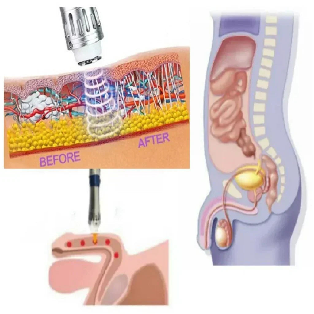 NovaPulse Portable Shockwave Therapy Device For Men With Case And Accessories | Lersk