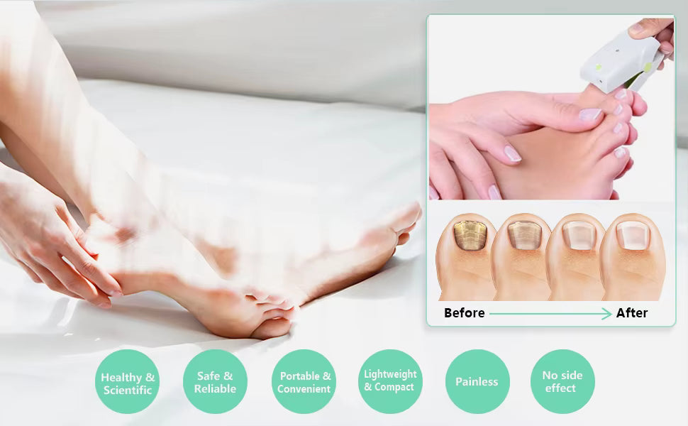 AureaPlex Nail Laser System For At Home Fungal Nails Cold Laser Therapy | Lersk