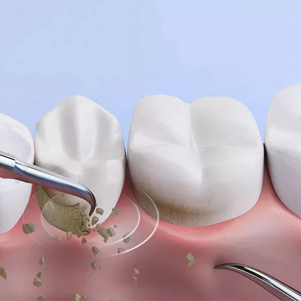 OralPro Plaque Remover | Home Dental Calculus Cleaner | Lersk