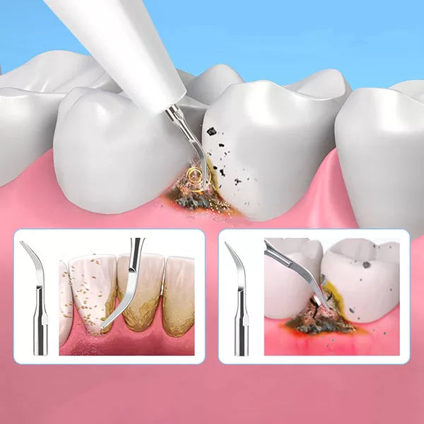 OralPro Plaque Remover | Home Dental Calculus Cleaner | Lersk