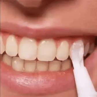 Rychlé bělení zubů pro zářivější úsměv | Lersk
