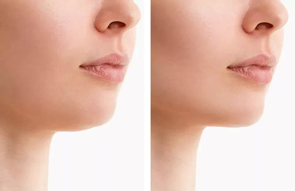 NovaLume ChinContour pás na terapii červeným světlem pro dvojitou bradu | Lersk