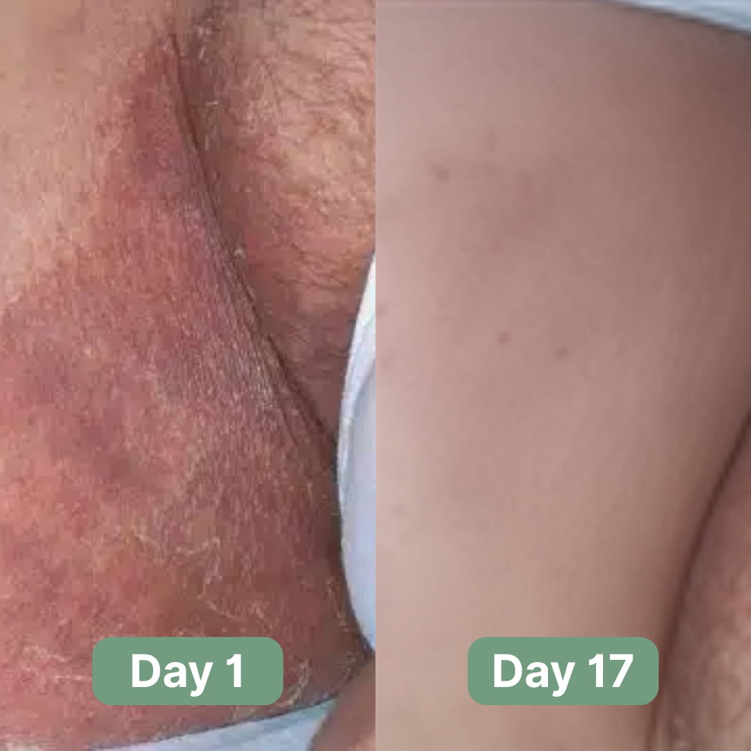 Veloma Antifungal Soap – Cílená úleva od tinea cruris | Lersk