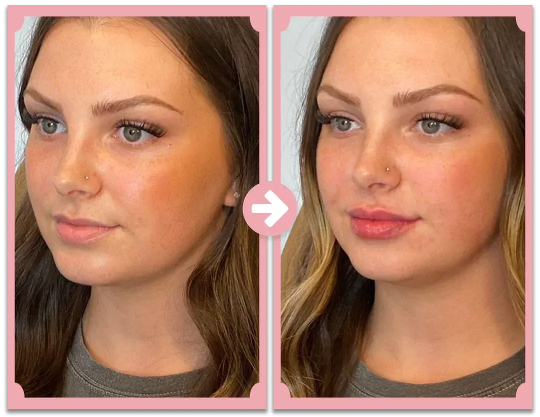 Poutify Plumping  Lip System | Lip booster kit | Lersk