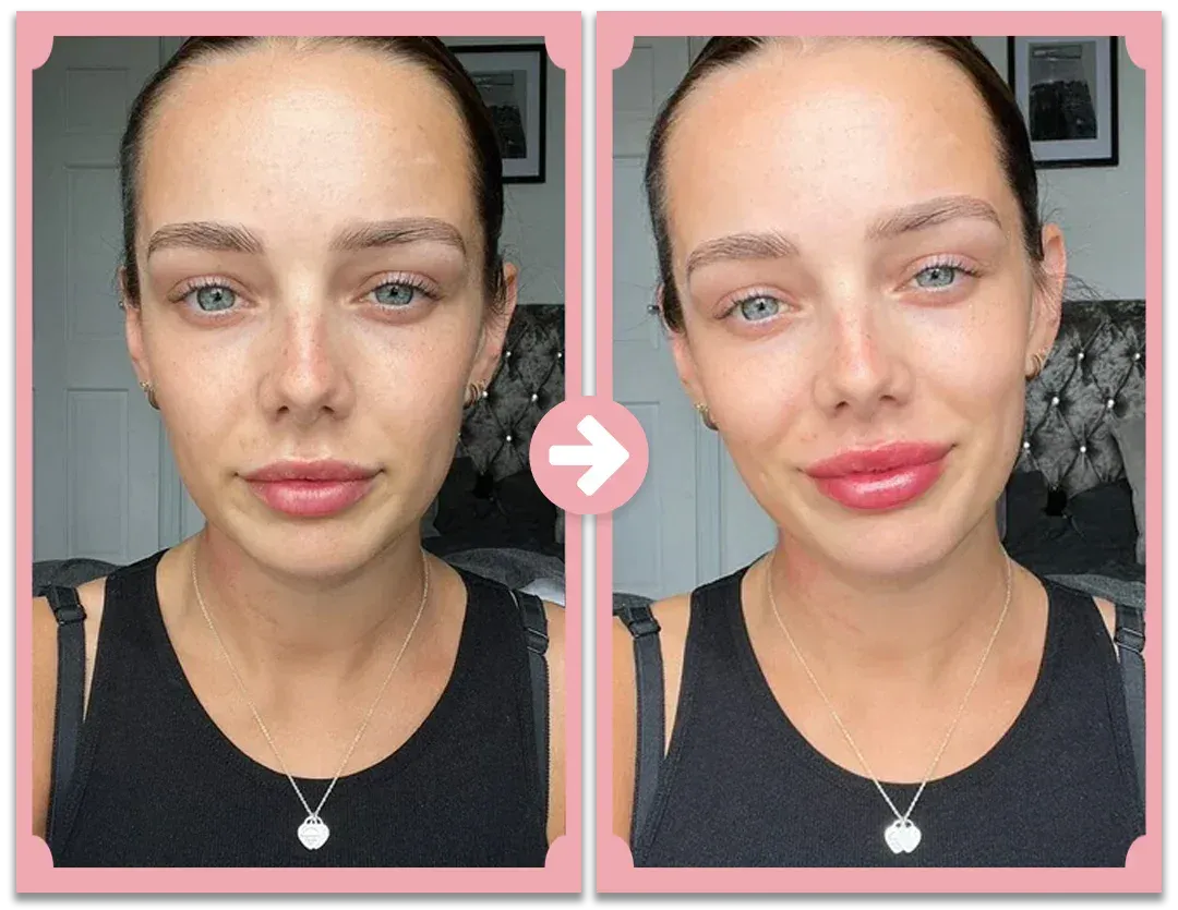 Poutify Plumping  Lip System | Lip booster kit | Lersk