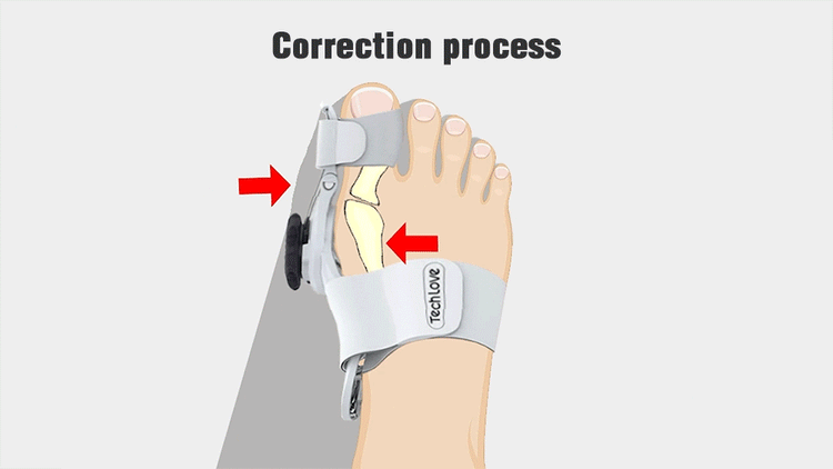 CalmStep | Nastavitelný korektor hallux valgus pro úlevu od bolesti | Lersk